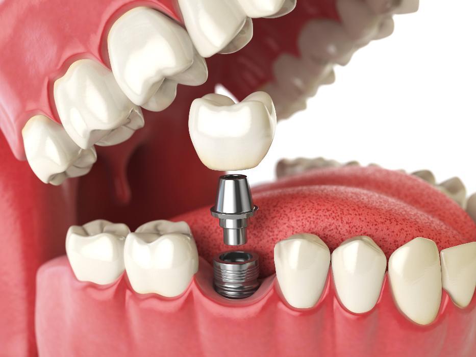 Dental Implant Diagram