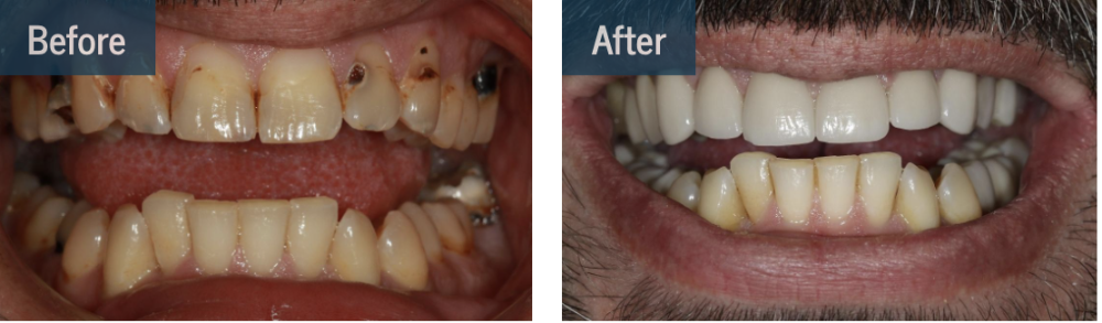 Before and after photos of patient dental crowns in Chesterfield