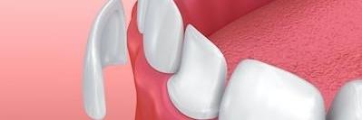 graphic of a dental veneer