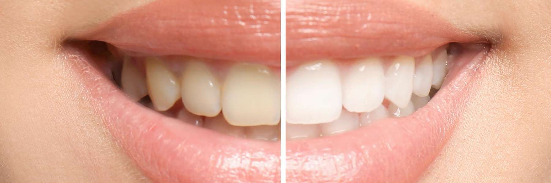 Before and after teeth whitening comparison