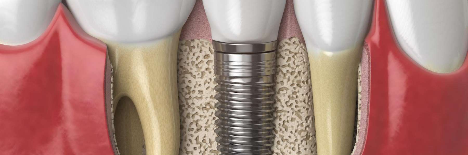 An illustration of a dental implant and screw in a jaw bone