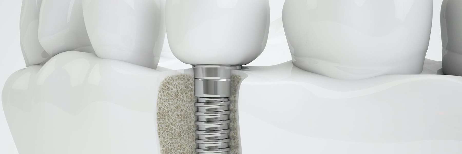 Illustration of a dental implant 