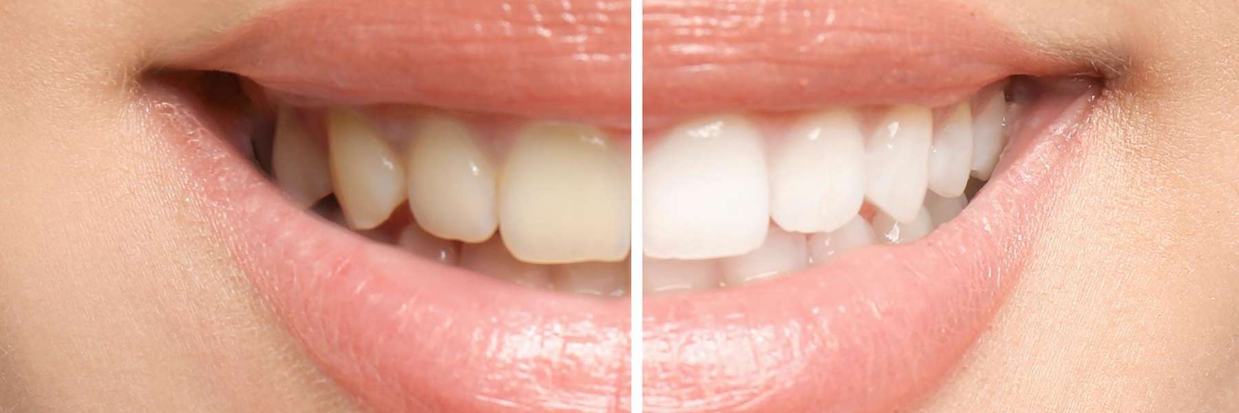 Tooth shade comparison photo | tooth whitening Chesterfield