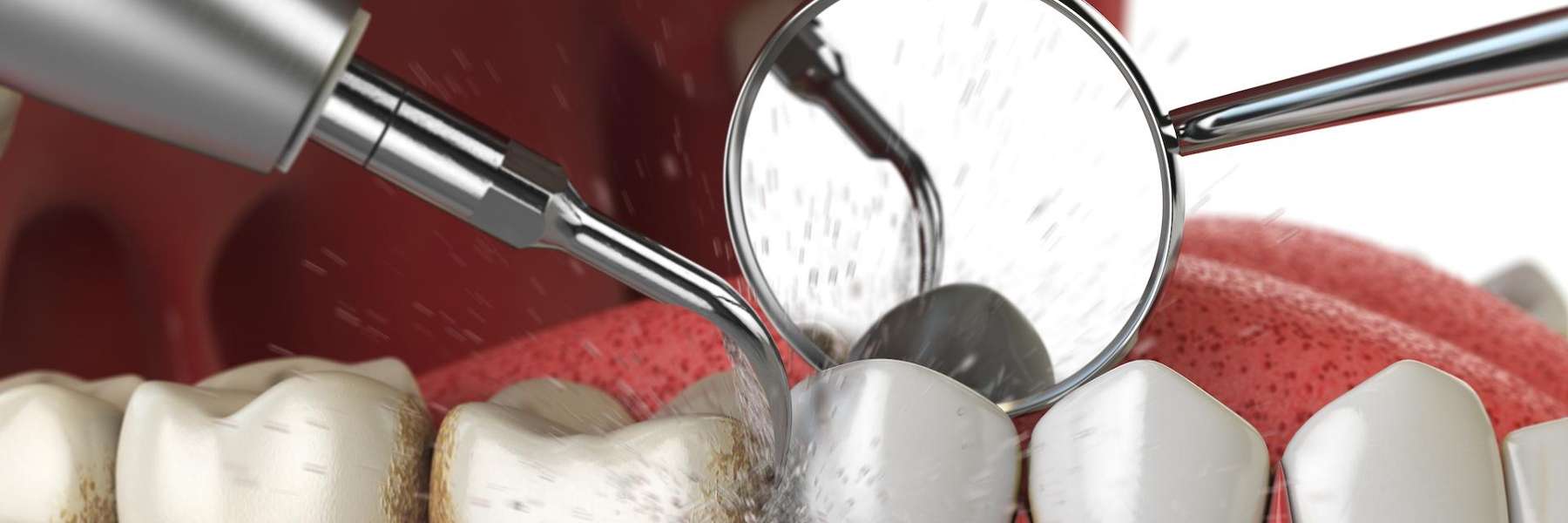 An illustration of a dental cleaning