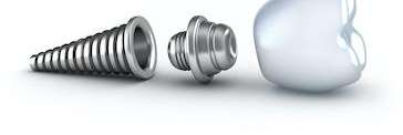 Diagram of Dental Implant in Chesterfield, MO