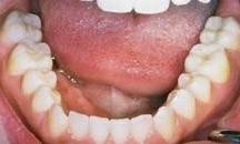 replacing metal fillings with tooth colored fillings