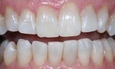 Dental patient after teeth whitening in Chesterfield