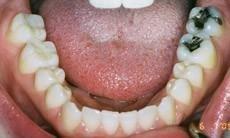 lower molars with metal fillings