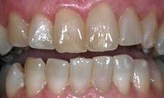 Chesterfield dental patient before teeth whitening